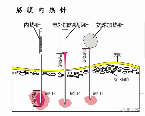 反复疼痛难以忍受疼痛科筋膜内热针了解一下